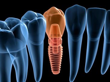 Best prices for Dental Implants in Miami and Coral Gables.