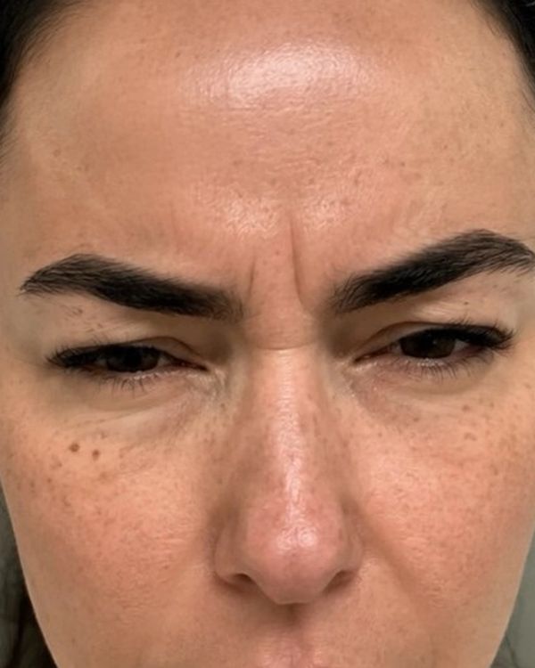 Botox — BEFORE. Individual results vary.