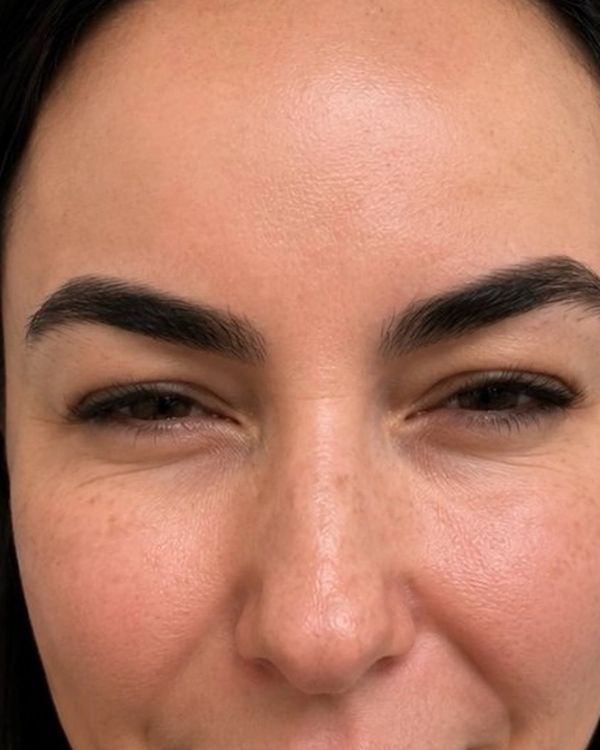 Botox — AFTER. Individual results vary.