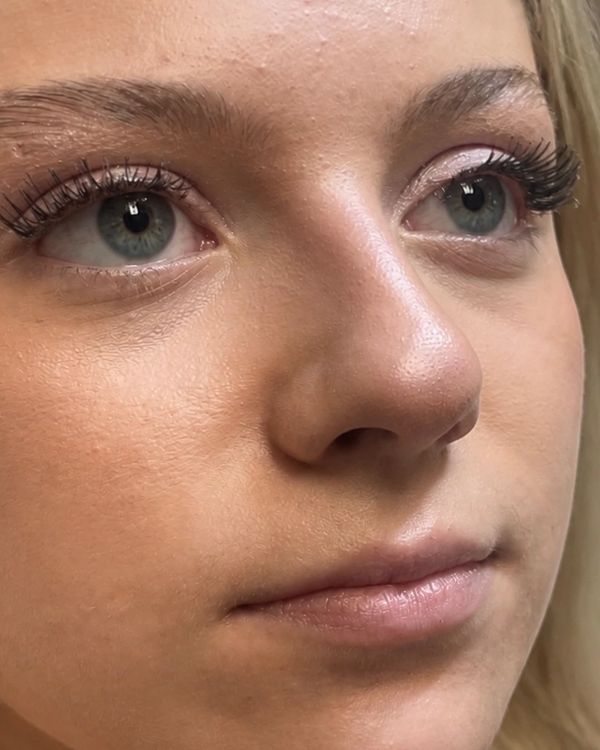 Lip filler — BEFORE. Individual results vary.