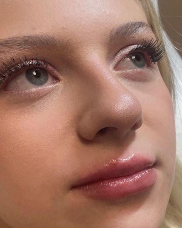 Lip filler — after treatment. Individual results vary.