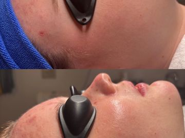 Comparison of skin before and after treatment showing clearer complexion.
