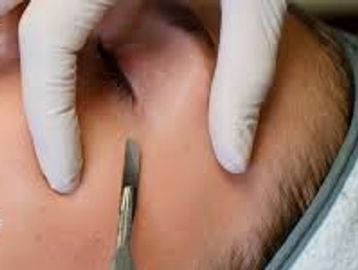A close-up of a facial skin treatment being performed with a scalpel.