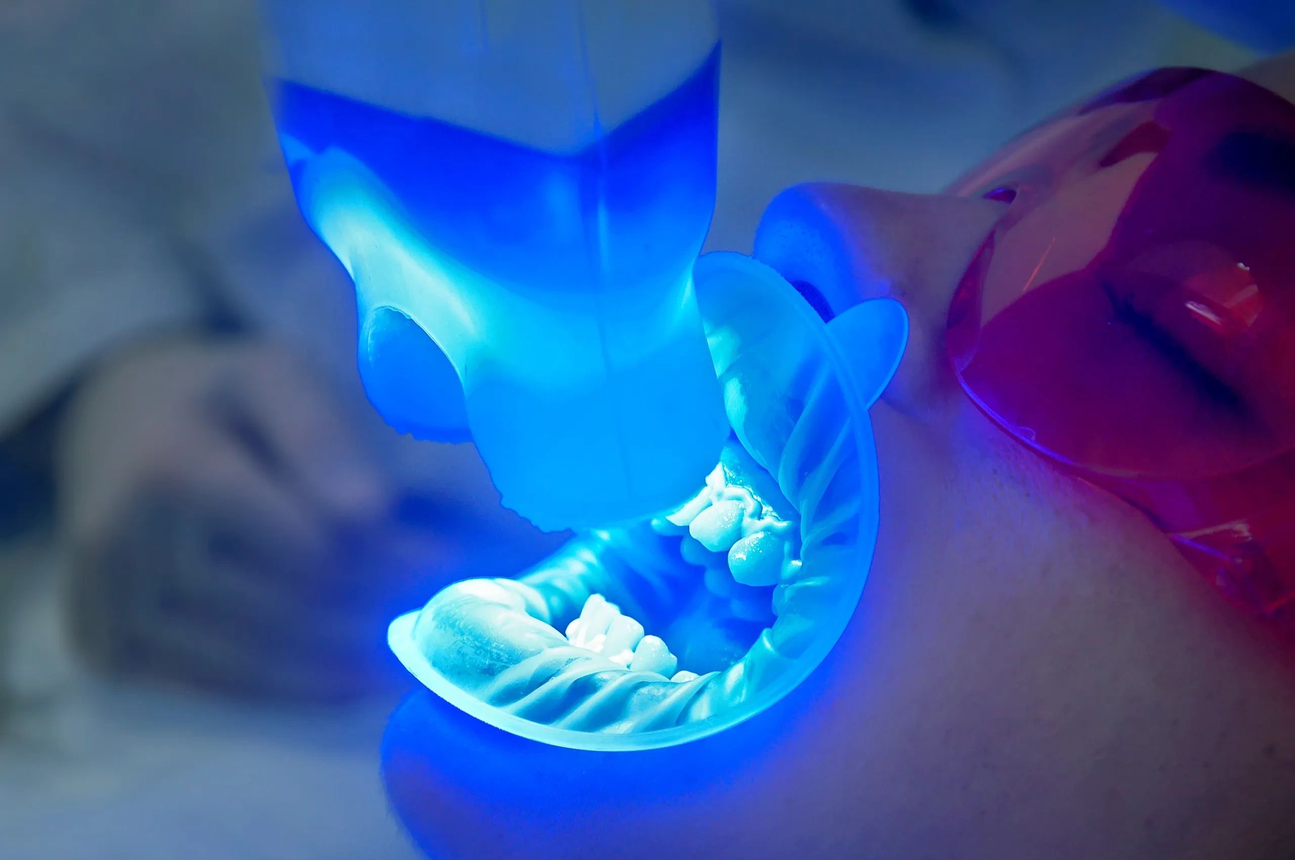 Professional Teeth Whitening vs. Over-the-Counter Products: What's the Difference?