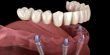 Dental implants supporting a full arch of prosthetic teeth.