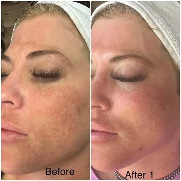 After 1 Peel. 3-4 Peel Series Recommended for Best Results.