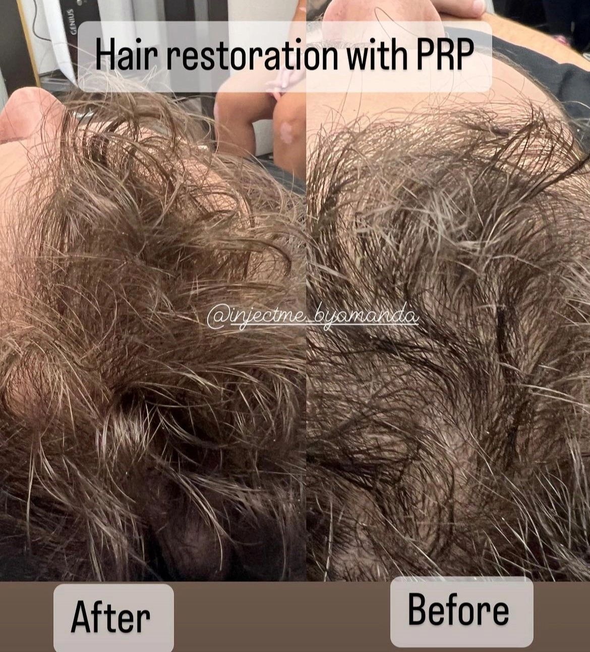 PRP/Hair Restoration Clinton MA