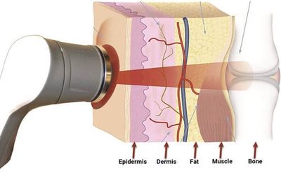 Berman Medical Laser Therapy: Relieve Jaw Pain & other Symptoms Associated with TMJD