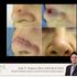 Skin Cancer, John Tedesco, Tulsa, reconstruction, surgeon, basal cell, carcinoma, cosmetic, repair