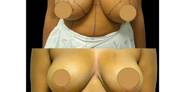 Breast Reduction and Lifts Dr. Tedesco, Green Country Surgical Arts, Tulsa, OK