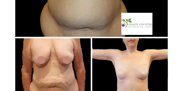 lift, liposuction, tummy tuck, mommy makeover,  Dr. Tedesco, Green Country Surgical Arts, Tulsa, OK
