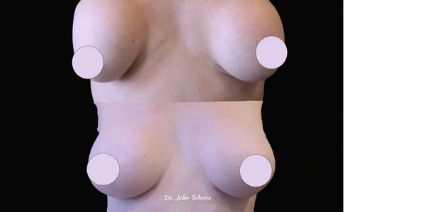 Breast implant exchange, explant with Dr. Tedesco, Green Country Surgical Arts, Tulsa, OK
