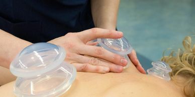 A woman getting a treatment called cupping