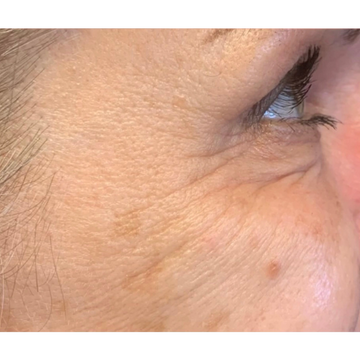 After Photo- No wrinkles on face