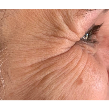 Before  Photo Wrinkles on face