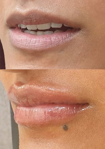 Dermal fillers specific for use in lips to gain symmetry, balance, volume and structure...immediate 