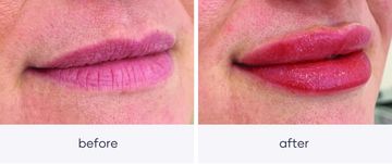 Lip Tattoo. Enhance, balance and contour lips with specialy selected pigment.