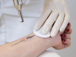 Laser Tattoo Removal