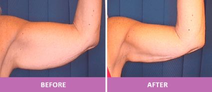 Flabby arms look better after BeautiFill™.