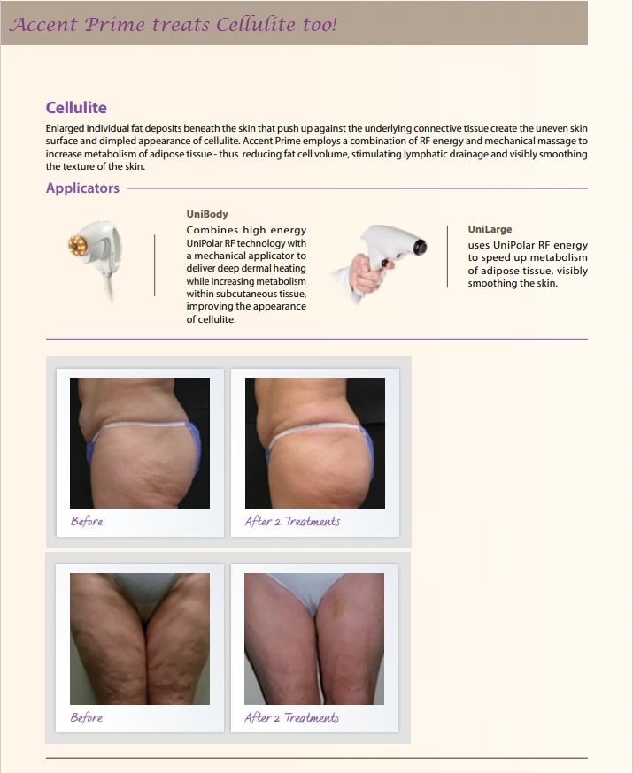 Bothered By Cellulite? 4 Cellulite Reduction Treatments That Work