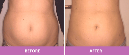 BeautiFill™ abdominal and flank liposuction.