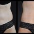 BeautiFill™ abdominal and flank liposuction. 