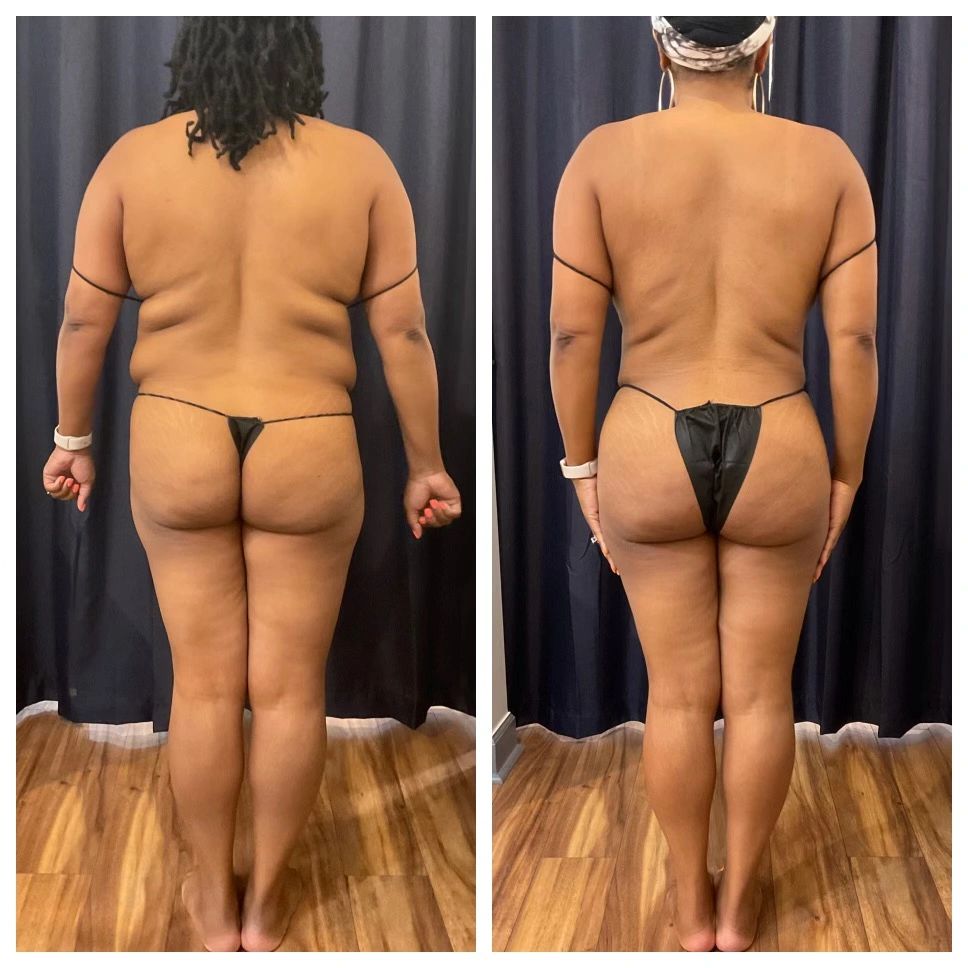 Laser Liposuction BBL Before and After