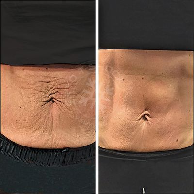CryoSlimming Fat Reduction vs CoolSculpting: Which is Better for You?