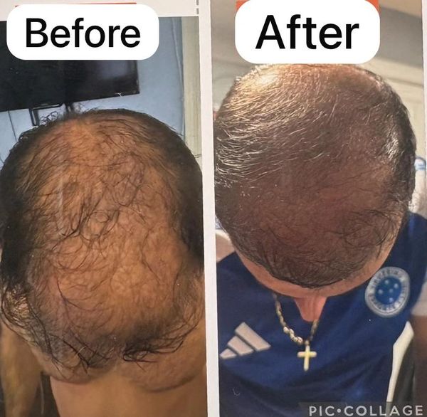 Before and after hair restoration showing significant hair regrowth.