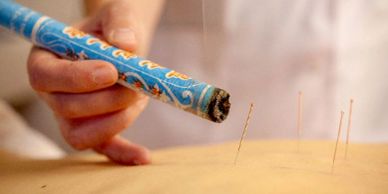 Moxibustion being used alongside Acupuncture needles