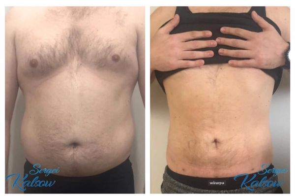 MALE LIPO 360 UNDER LOCAL ANESTHESIA