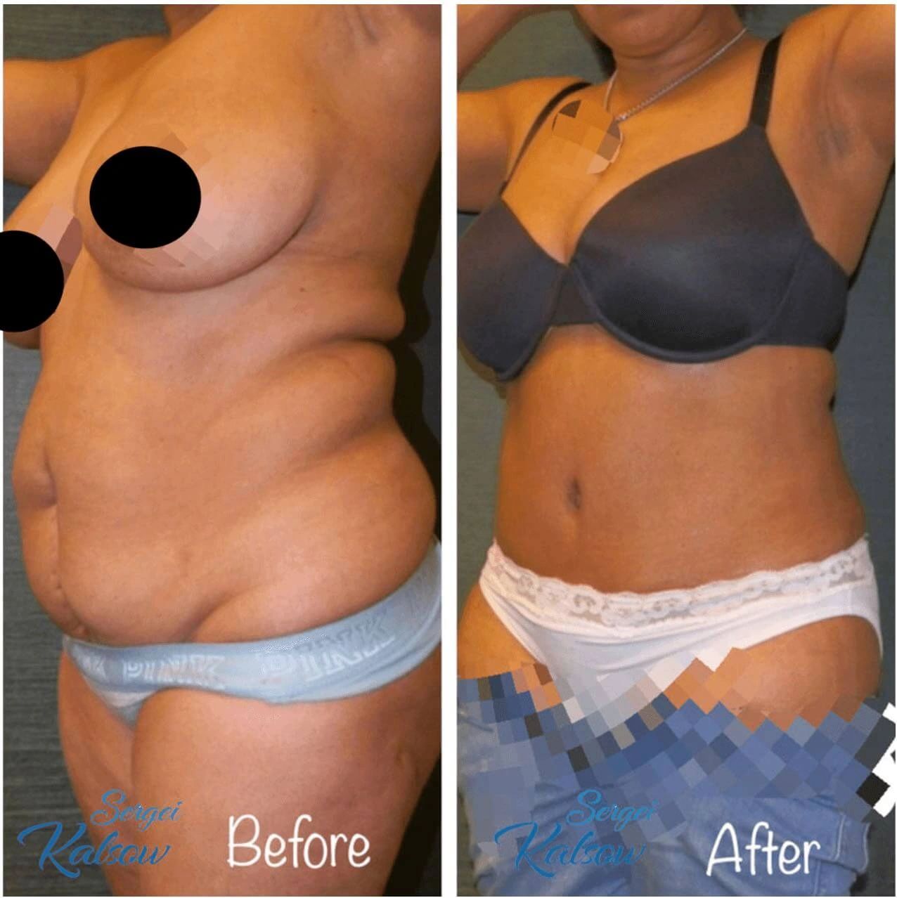 Full tummy tuck/abdominoplasty.  The after photo shows a natural result with a flatter stomach, natural belly button, and a thinner waist.  