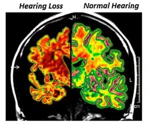Brains scan showing brain activity of someone with a hearing loss vs someone with normal hearing.