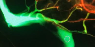 3D angiogram showing stenosis in vein in the head, causing increased intracranial pressure, or IIH