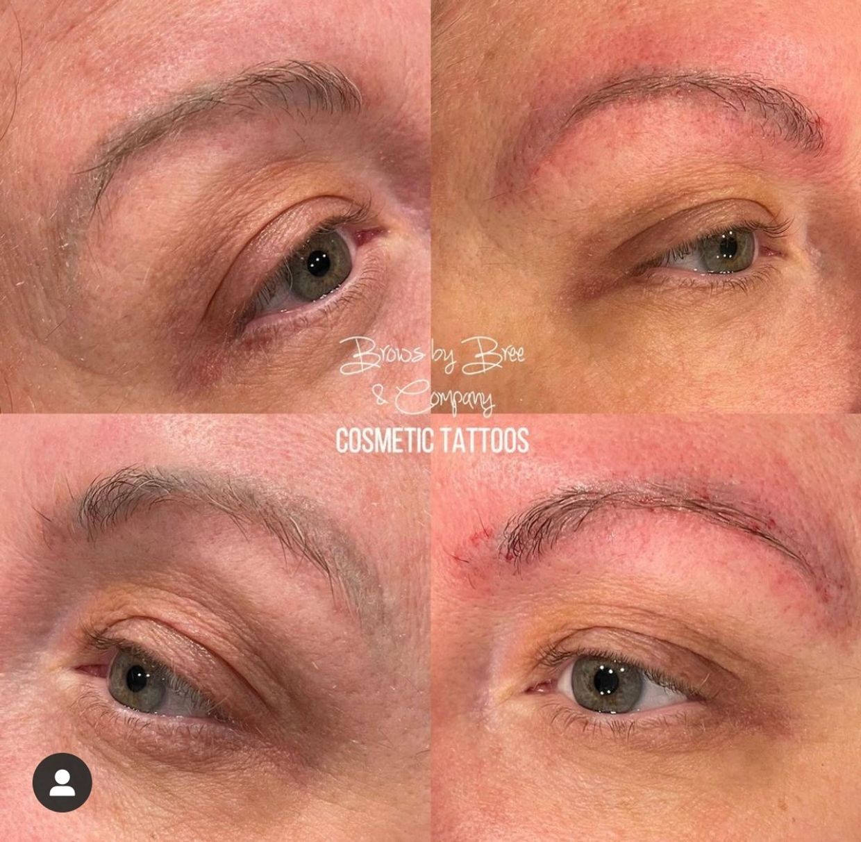 saline tattoo removal on micro bladed eyebrows