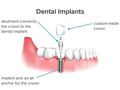 Dental implants in chandigarh 