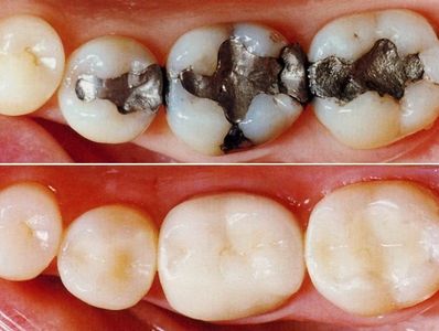 Dental fillings