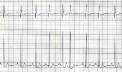 ECG