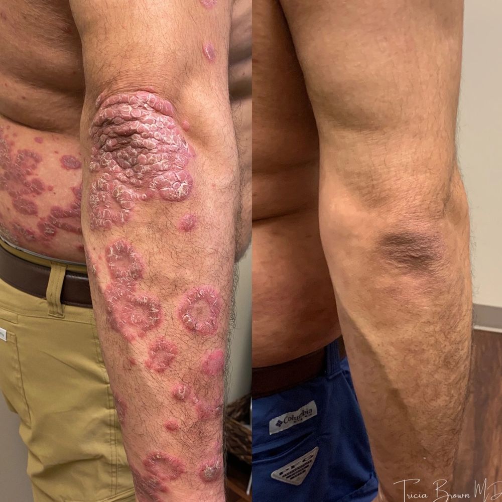 Before and after images of a man's arm showing severe psoriasis and clear skin post-treatment.