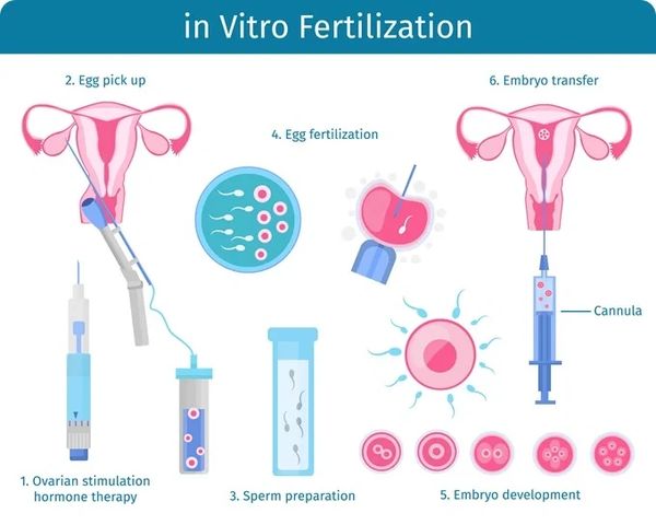 In Vitro Fertilization procedure and process