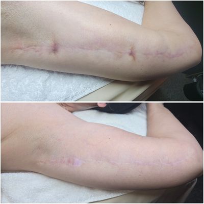 Alkaline Scar Revision