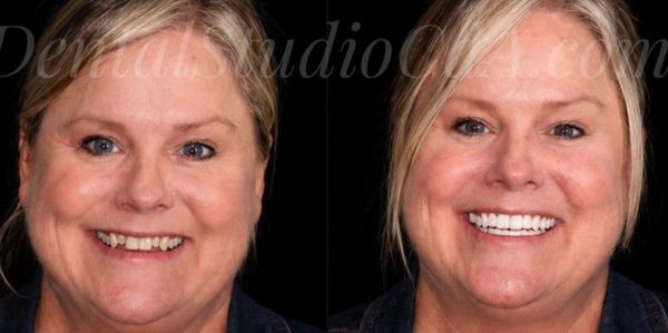 Before and after dental smile makeover on a woman.