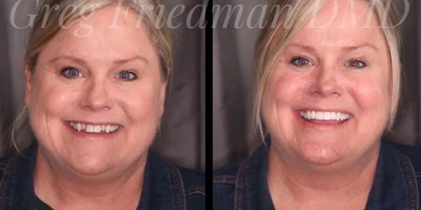 Smile Makeover Before and After