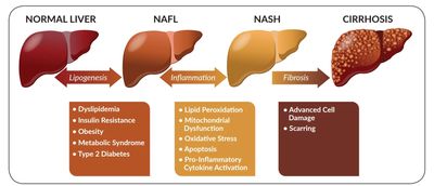 NAFLD Fatty Liver with  inflammation can lead to NASH and then Fibrosis and Cirrhosis 