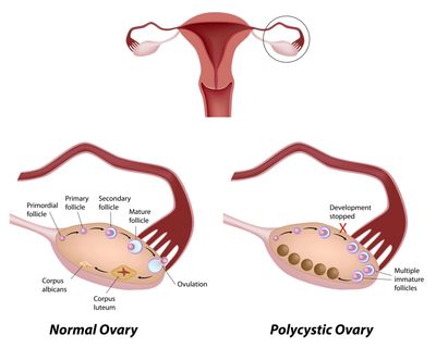 PCOS endocrine & metabolic disorder characterized by infertility obesity  insulin resistance