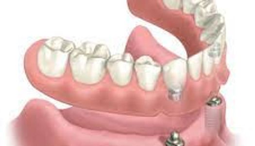 Prothese Dentaire - GUY GRONDIN DENTUROLOGISTE