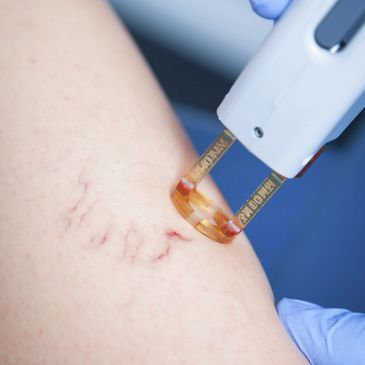 Spider vein treatment  aimed at eliminating or reducing the appearance of spider veins