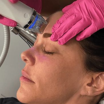 Potenza’s revolutionary RF microneedling technology is minimally invasive and non-surgical