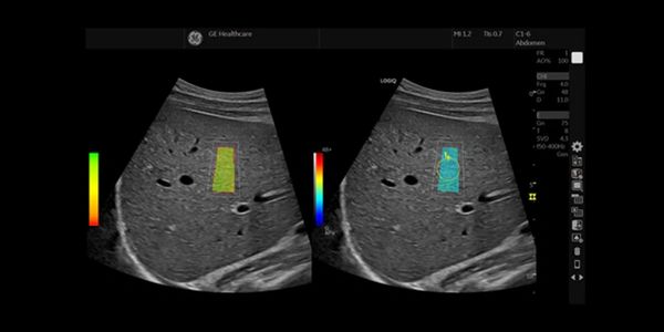 Elastografía hepática, técnica de Onda de Corte (Shear Wave) para evaluar fibrosis hepática.