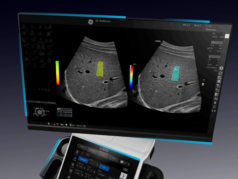 Ultrasonido con Elastografía Hepática y Cuantificación del Hígado Graso, ùnico en Guatemala.